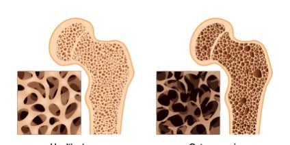 fractures-and-bone-density-2