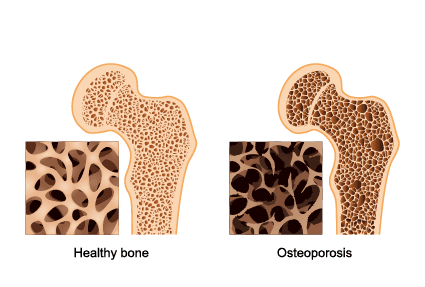 fractures-and-bone-density-2